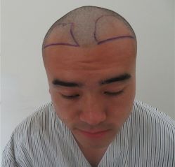 -碧莲盛·不剃发植发