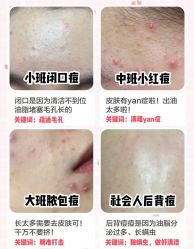 -苗方清颜痘肌研究所