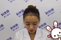 点击看大图 -大麦微针植发丨全国连锁