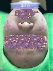 -苗医生草本科技祛痘