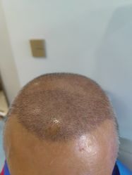 -碧莲盛·不剃发植发