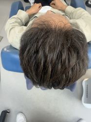 -大麦微针植发全国连锁
