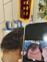 -碧莲盛·不剃发植发