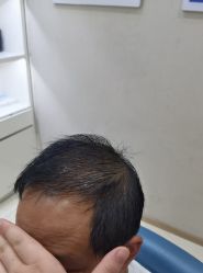 -大麦微针植发丨全国连锁