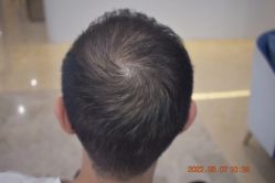 -大麦微针植发全国连锁