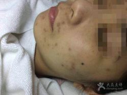 -苗方清颜专业祛痘
