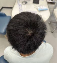 体验后-大麦微针植发全国连锁