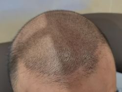 -碧莲盛·不剃发植发