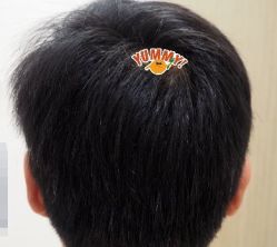 -大麦微针植发丨全国连锁