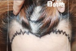 -大麦微针植发全国连锁