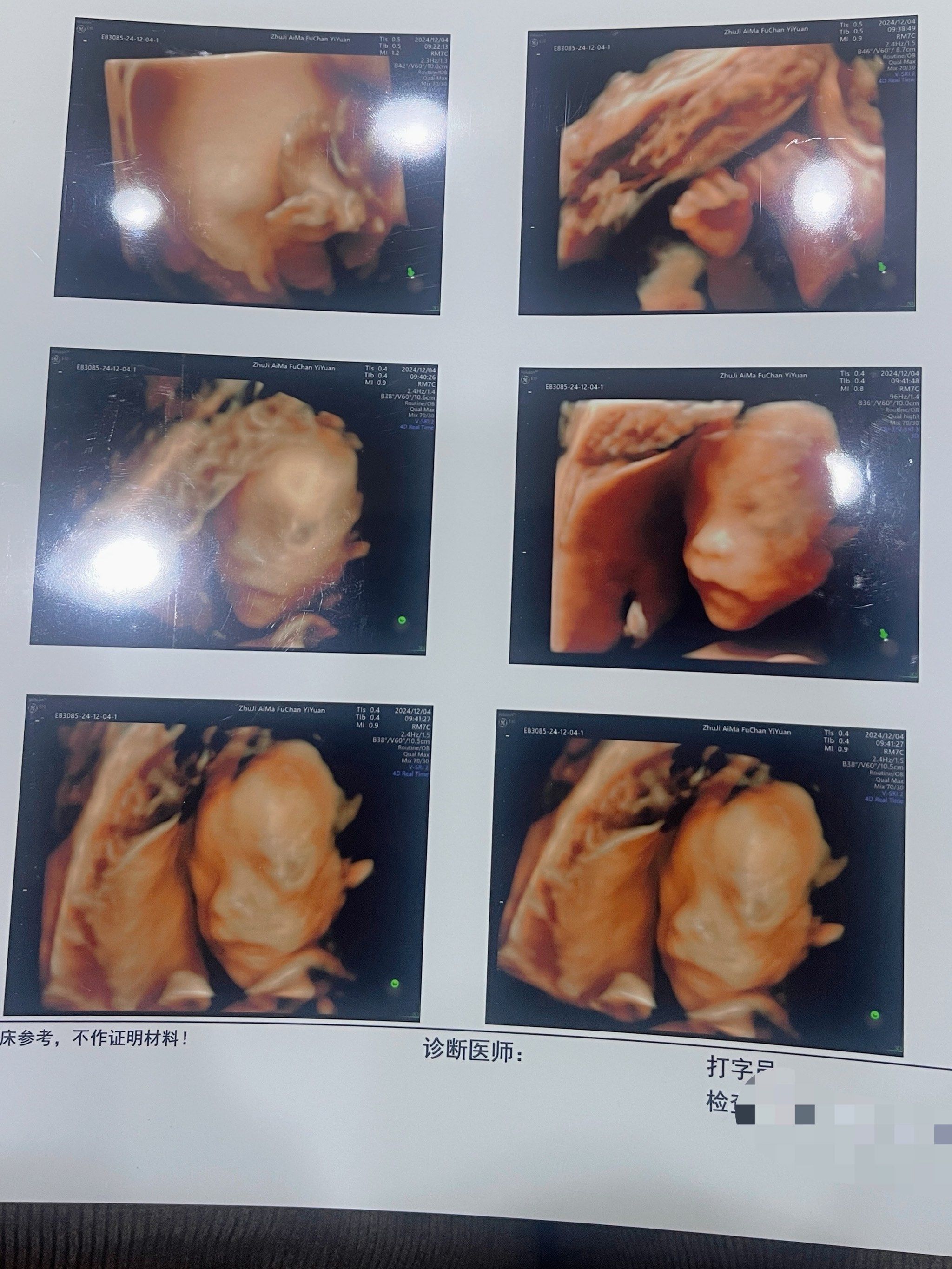 在艾玛和宝宝的四维合照