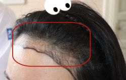 -大麦微针植发全国连锁