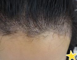 -大麦微针植发丨全国连锁