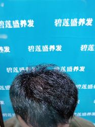 -碧莲盛·不剃发植发