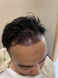 -大麦微针植发丨全国连锁