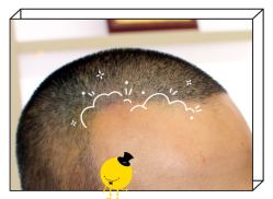 -大麦微针植发全国连锁