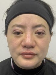 -天津健丽·去眼袋医疗美容机构