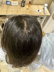 -碧莲盛·不剃发植发