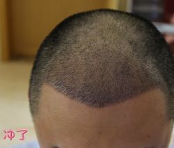 -大麦微针植发丨全国连锁