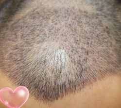 -大麦微针植发丨全国连锁