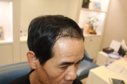 -大麦微针植发丨全国连锁