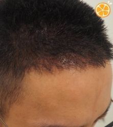 -大麦微针植发丨全国连锁