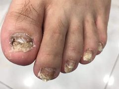 -世龙世家灰指甲·甲沟炎·跖疣护理·修脚(东江湾路店)