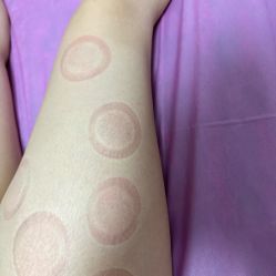 -莲芸拔罐减肥