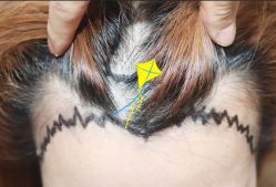 -大麦微针植发全国连锁