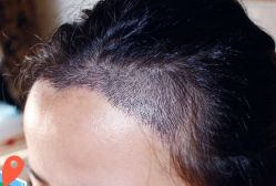 -大麦微针植发丨全国连锁