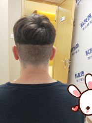 点击看大图 -大麦微针植发丨全国连锁