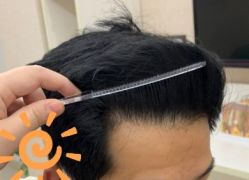 -大麦微针植发丨全国连锁