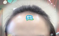 -大麦微针植发全国连锁