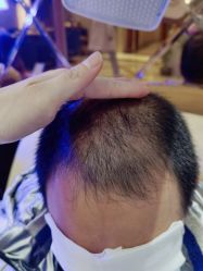 点击看大图 -碧莲盛·不剃发植发