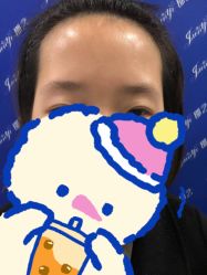 体验前-郡艺医疗美容·微整·眼鼻吸脂