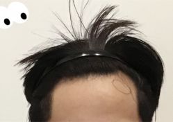 -大麦微针植发全国连锁