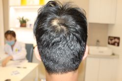 -大麦微针植发丨全国连锁