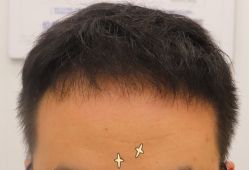 -大麦微针植发全国连锁