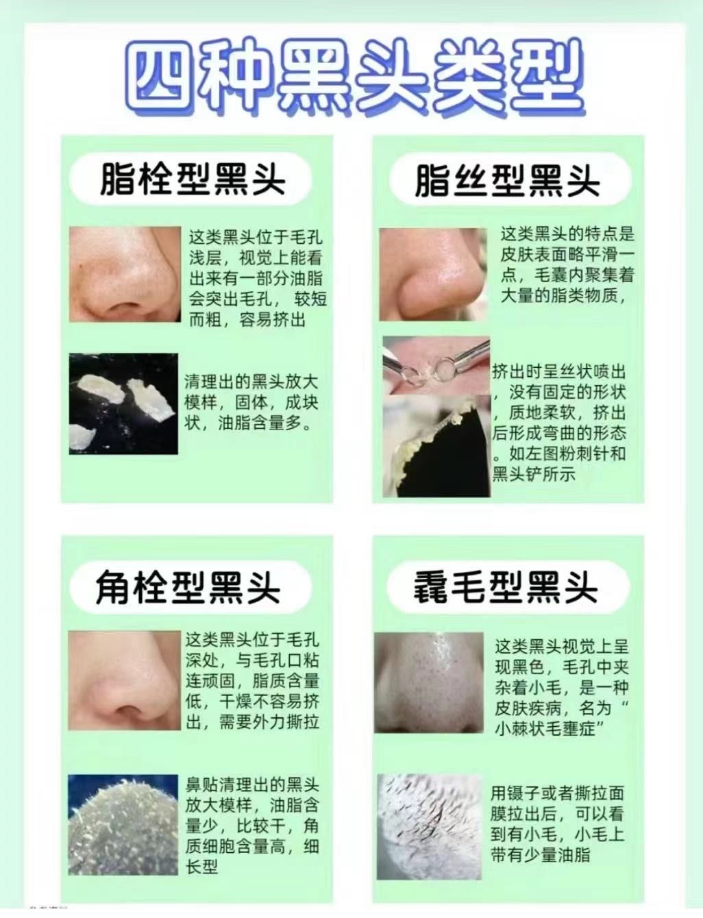 n当皮脂腺分泌旺盛时会产生较多的油脂,堵塞住毛孔.