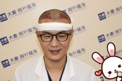 点击看大图 -大麦微针植发丨全国连锁