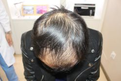 -大麦微针植发丨全国连锁