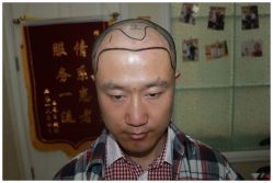 -大麦微针植发全国连锁