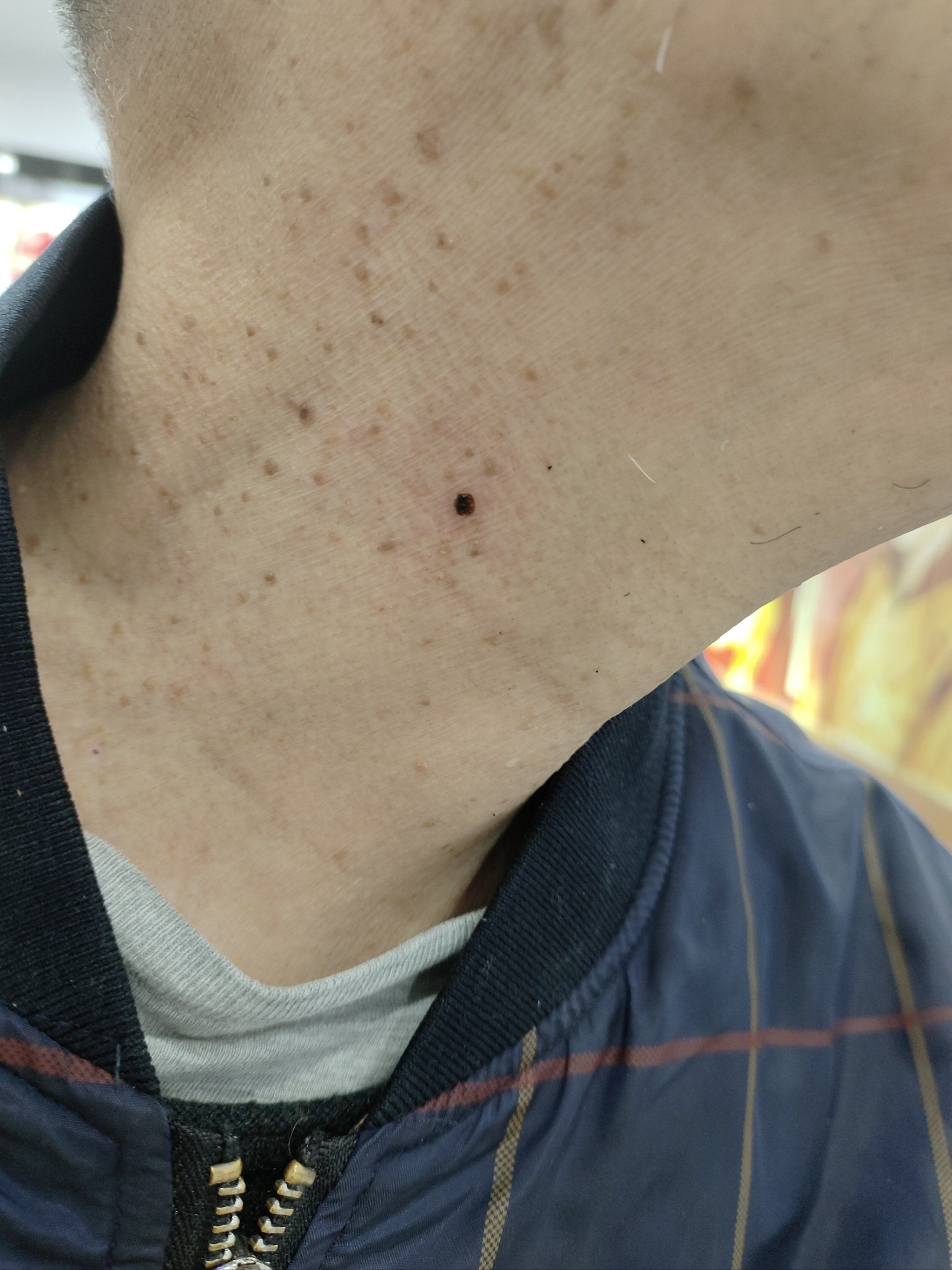 脖子上疣有的可以看过来,一颗的时候没有管