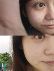 体验前-东莞壹加壹整形美容医院
