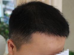 -大麦微针植发全国连锁
