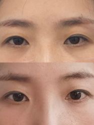 -天津健丽·去眼袋医疗美容机构