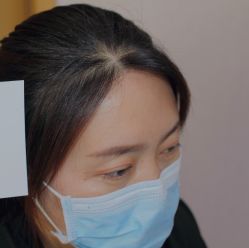 体验后-大麦微针植发全国连锁