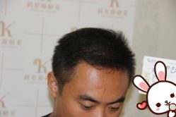 点击看大图 -大麦微针植发丨全国连锁