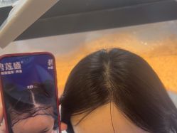 -碧莲盛·不剃发植发