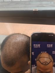 -碧莲盛·不剃发植发